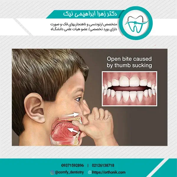مکیدن شست و اثرات آن بر دندان